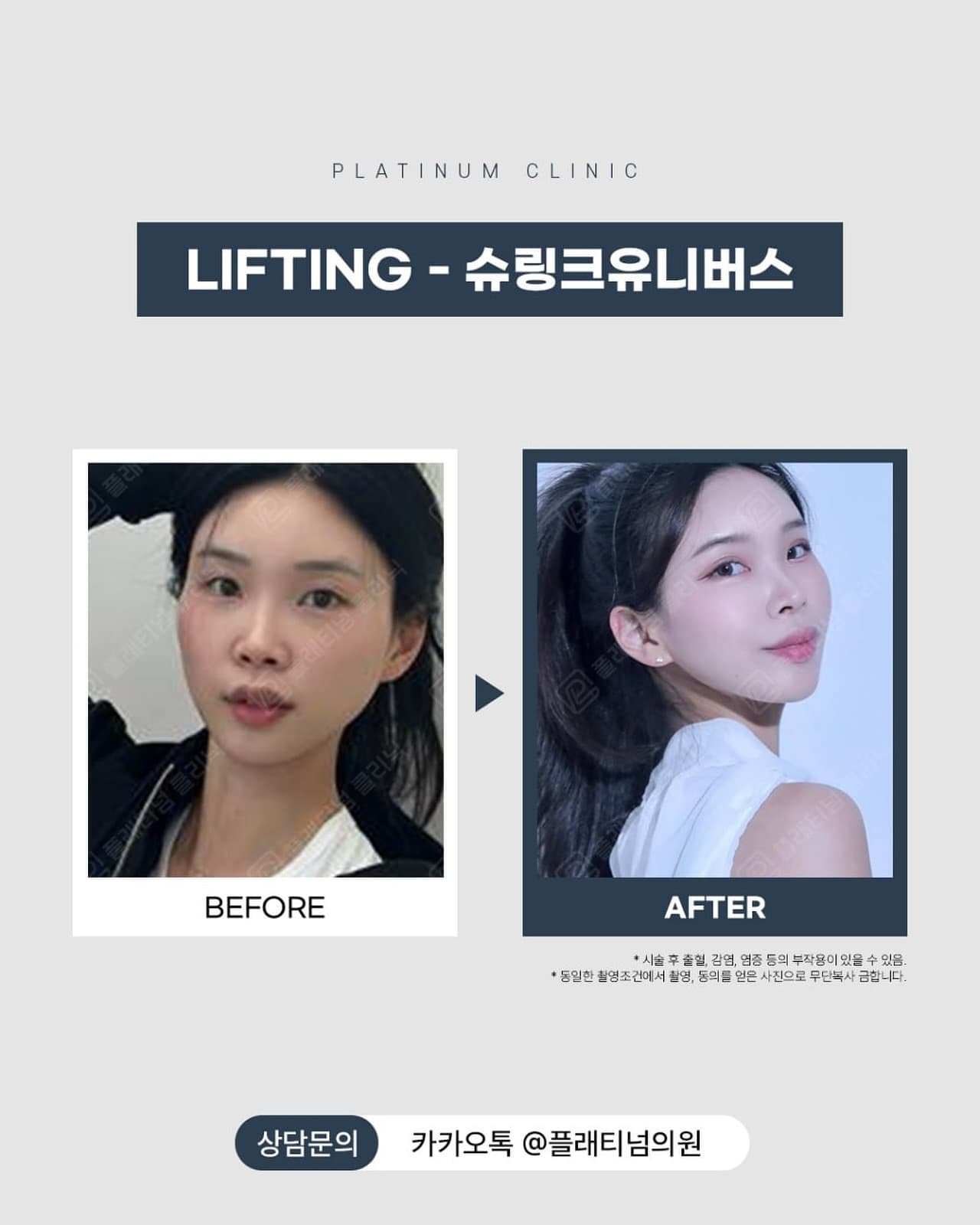 Shrink Lifting Before & After Comparison