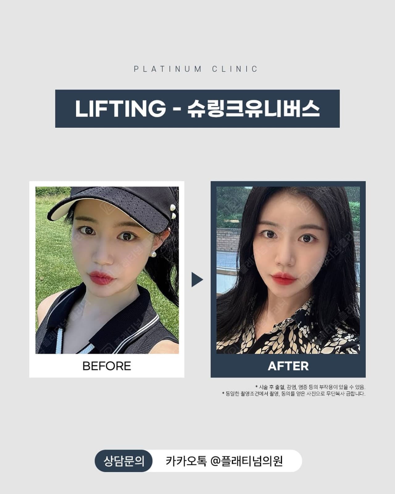 HIFU 리프팅 2회차 결과