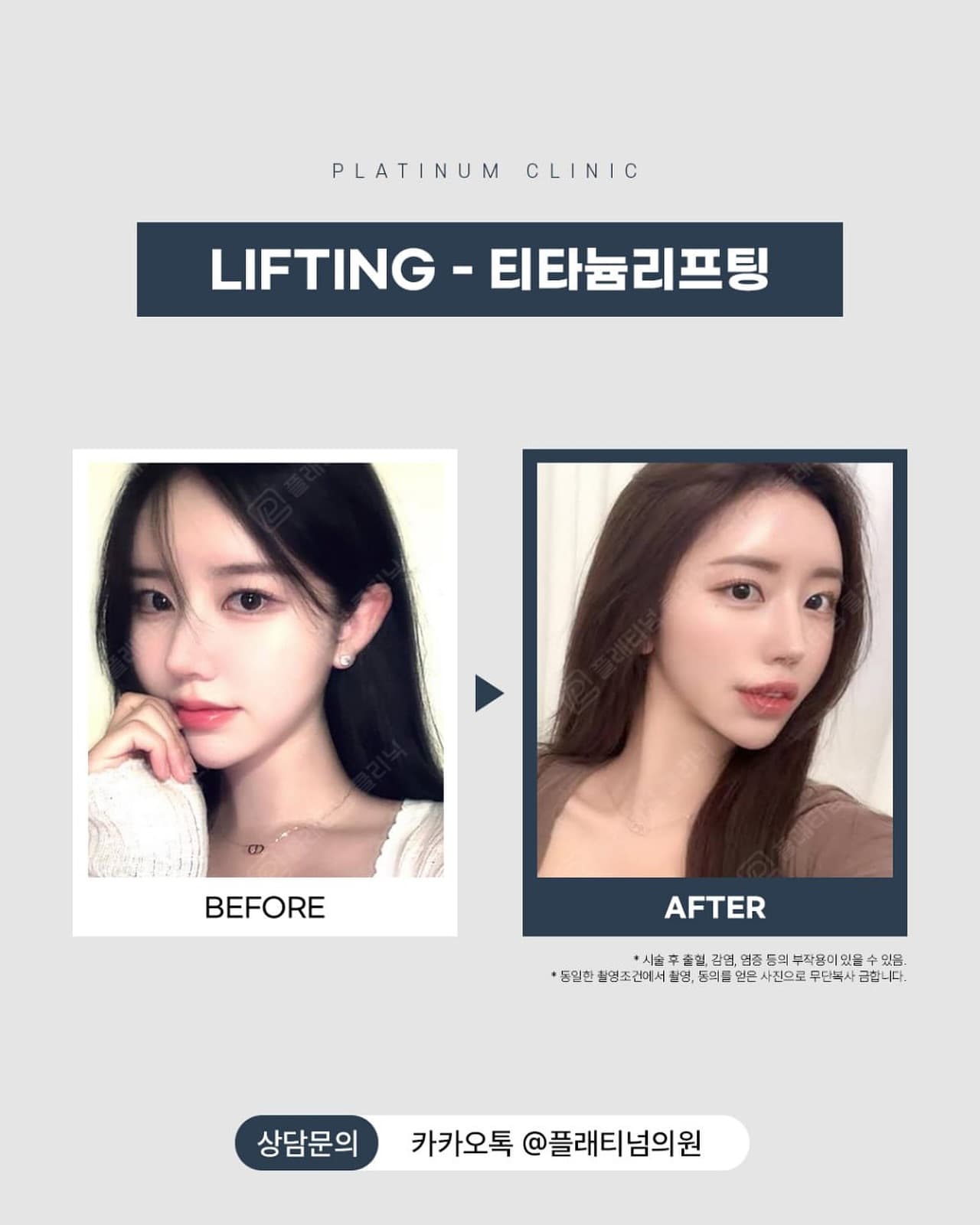 티타늄 리프팅 8일차 비포애프터