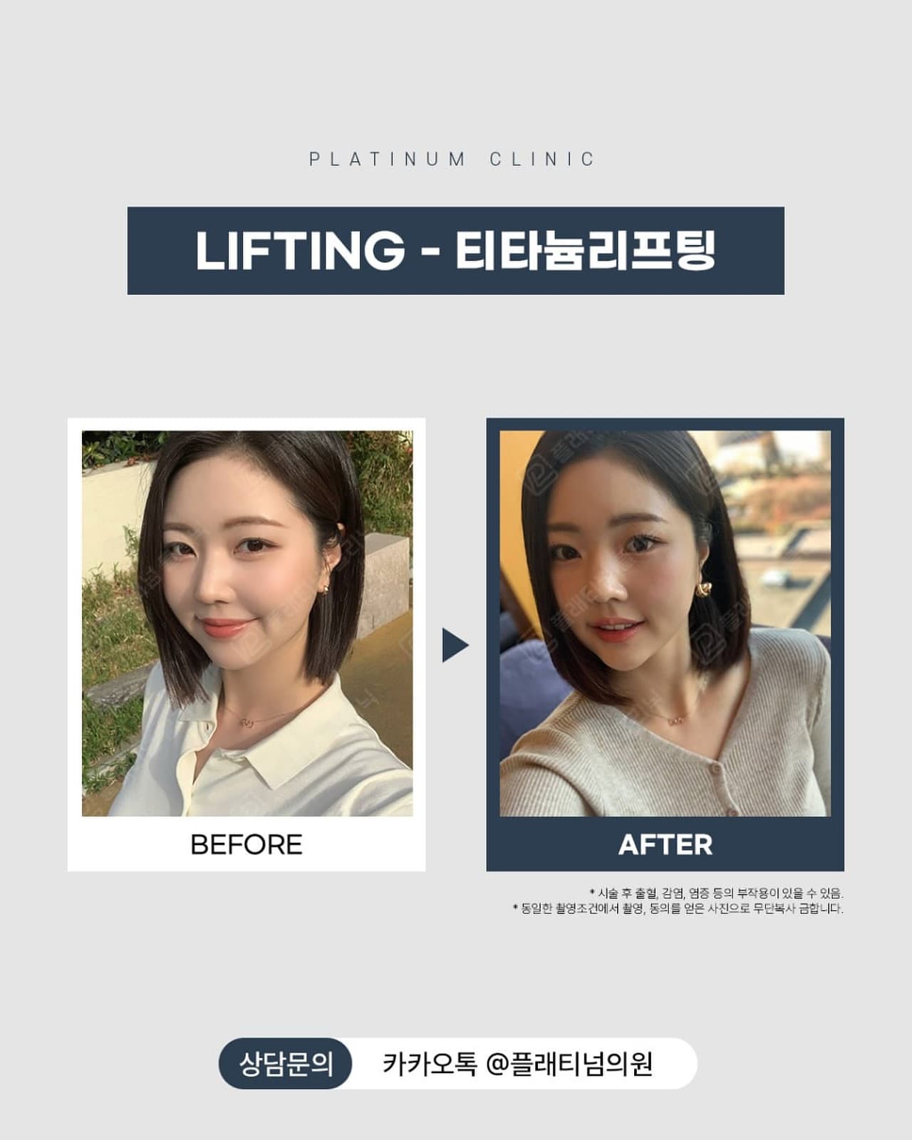 다운타임 없는 티타늄 리프팅