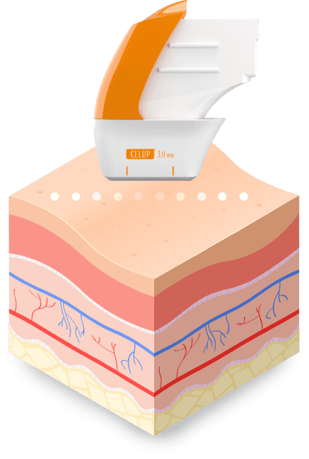 Dot Type — SMAS layer